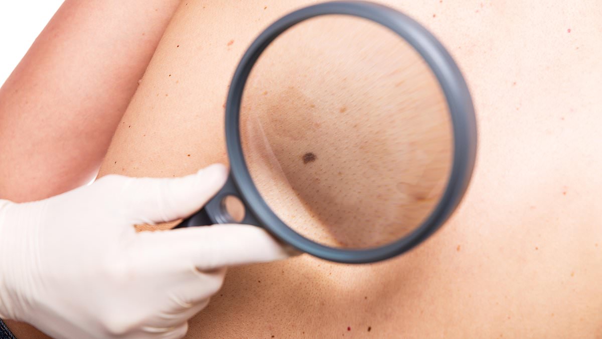 What is melanoma? Your questions about the skin cancer answered after Sarah Ferguson’s diagnosis – including how to check your moles [Video]