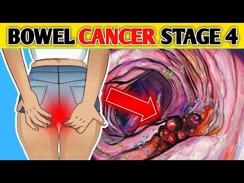 Stop These 5 Foods That Causes Bowel Cancer – Foods Causing Colon Cancer – Nourish360 [Video]