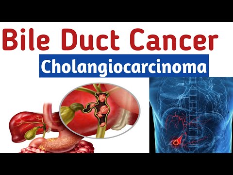 Bile Duct Cancer/ Cholangiocarcinoma- Types, Symptoms, Diagnosis And Treatment| Dr. Khalil Ur Rehman [Video]