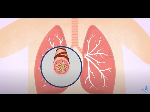 Asthma Triggers in Children [Video]