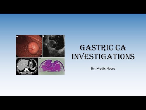 Investigations for gastric cancer – diagnostic, staging, assessment of complications [Video]
