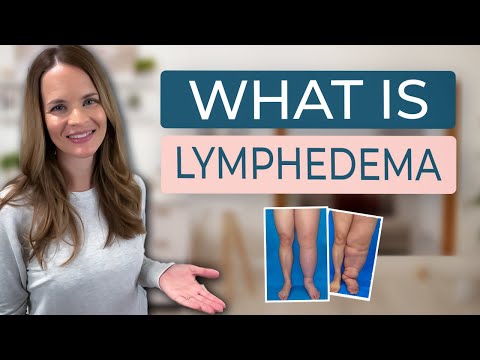 What is Lymphedema? [Video]