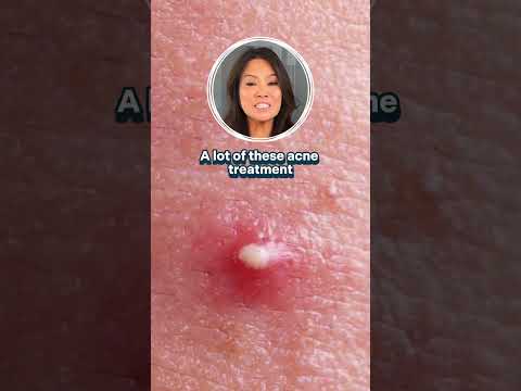 Anyone that gets acne should have spot treatments handy – here’s why! [Video]