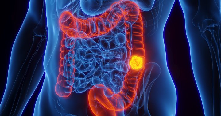 Drug for cocaine addiction could help treat colorectal cancer, research shows [Video]