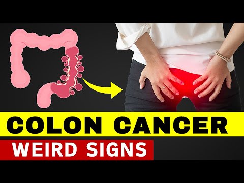 8 Signs You Might Have Colon Cancer: Are You at Risk? [Video]