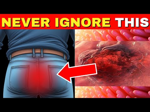 Critical Colon Cancer Symptoms You Should Never Ignore [Video]