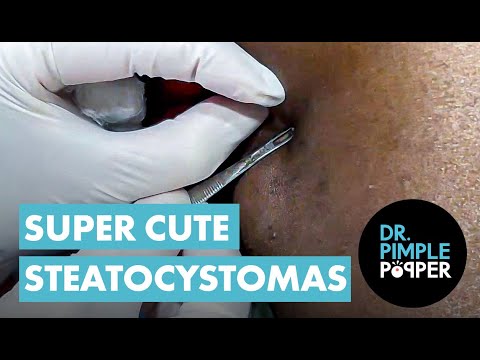 A stubborn Steatocystoma [Video]