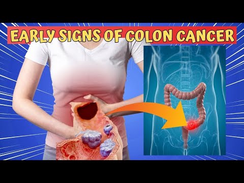 Early Signs of Colon Cancer You Should Know [Video]