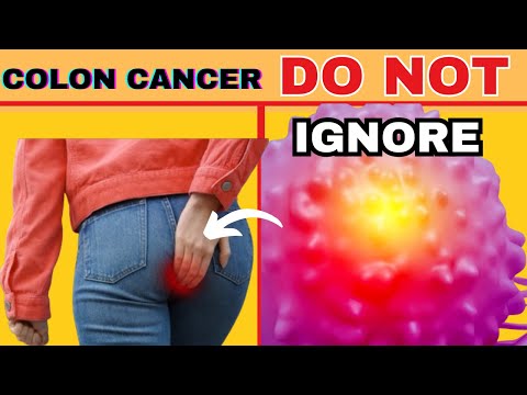 10 CRITICAL COLON CANCER SYMPTOMS YOU SHOULD NEVER IGNORE [Video]