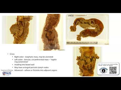Colon: Adenocarcinoma (Gross Pathology) [Video]