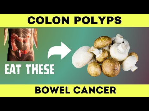Protect Your Colon: 10 Best Foods to Eliminate Polyps & Prevent Cancer [Video]