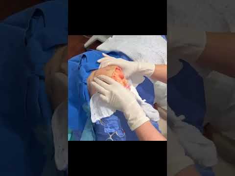 This amazing lipoma on the deltoid came into the office – full video tagged here!