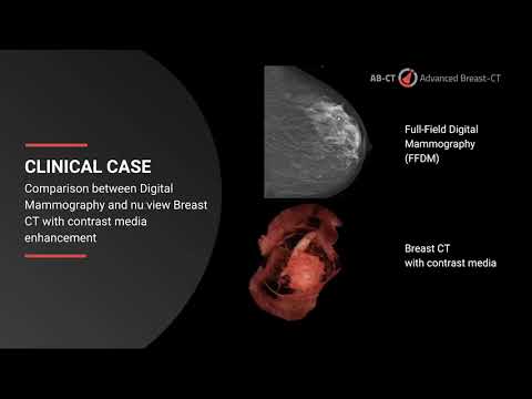 Breast CT with contrast media in comparison to Mammography [Video]