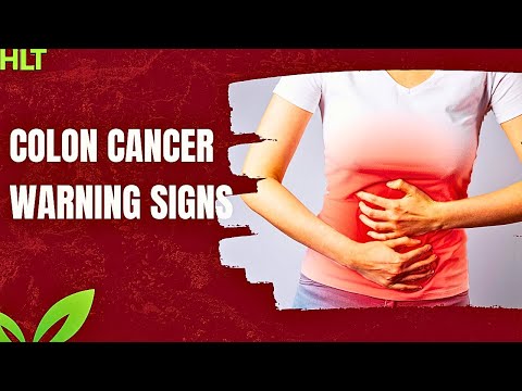 Top 10 Early Warning Signs of Colon Cancer [Video]