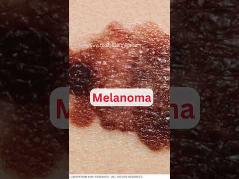 Symptoms of Skin Cancer | Skin Cancer  Cancer [Video]