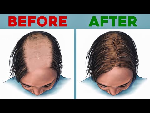 The Top 3 Foods for Hair Loss [Video]