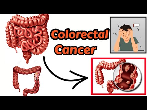 Understanding Colon Cancer (colorectal cancer) [Video]