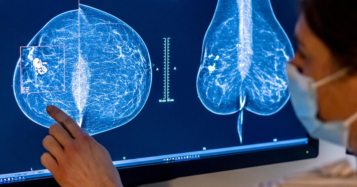 Indiana bill alerting women of breast density passes Senate | News [Video]