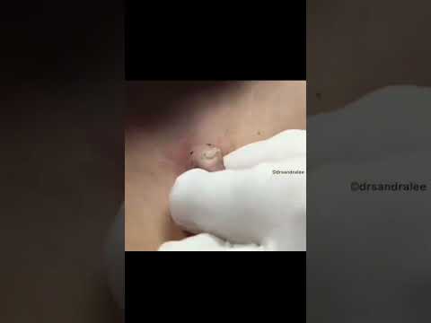Here is an example of a cyst extraction using a Punch Excision Tool [Video]