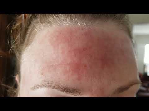 My Daughters Day 14 Forehead/Temple (Morning) 5% Fluorouracil Treatment (36 Years Old) 2-15-2024 [Video]