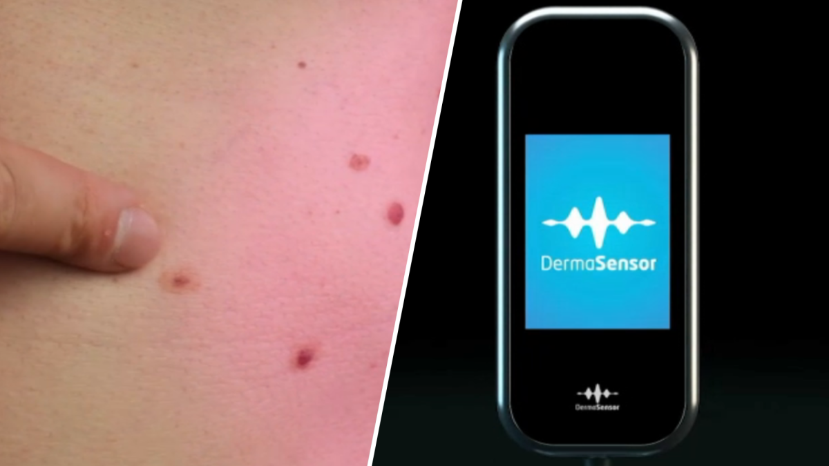 How an AI device the size of a phone detects skin cancer  NBC Bay Area [Video]