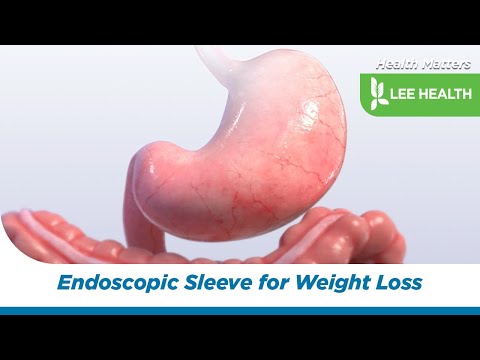 Endoscopic Sleeve for Weight Loss [Video]