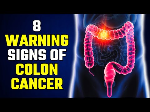 What Are the Symptoms of STAGE 1 COLON CANCER [Video]