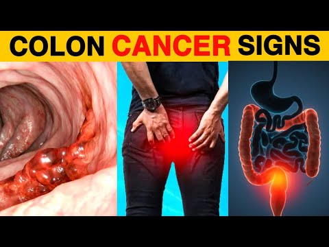 9 Critical Signs of Colon Cancer to Look Out For [Video]