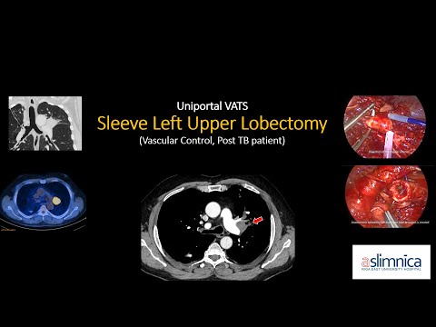 Sleeve Left Upper Lobectomy (Vascular Control, PostTB patient) [Video]