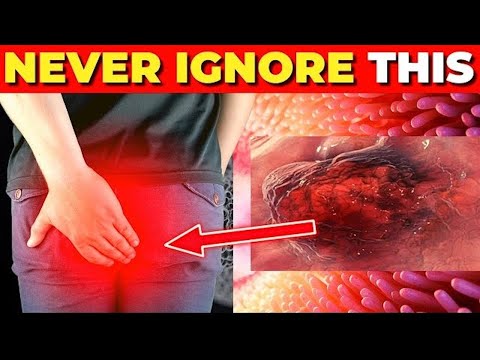 Listen to Your Gut: Early Warning Signs of Colon Cancer You Shouldn’t Ignore [Video]