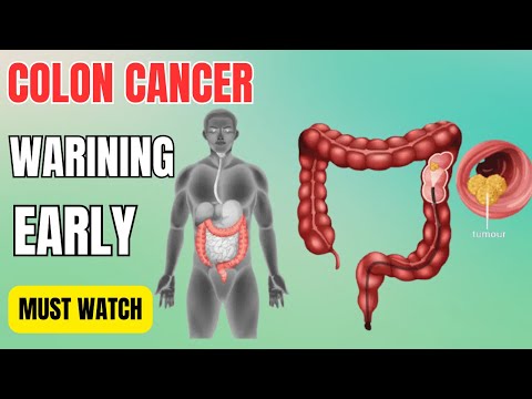 Top 10 Early Warning Signs of Colon Cancer [Warning] [Video]