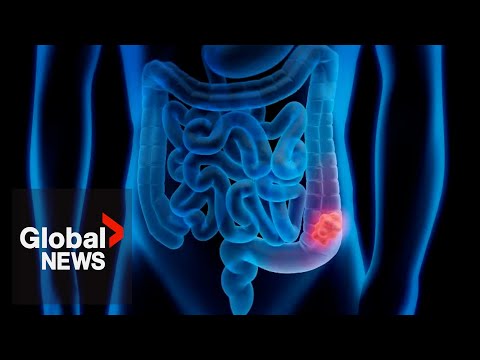Calls for colorectal cancer screening age be lowered as cases rise in young adults [Video]