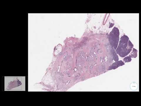 Pancreas Neoplastic Cases Serous, intraductal, papillary, mucinous, cystic, acinar, adenocarcinoma [Video]