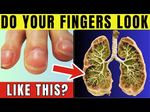 11 Warning SIGNS of LUNG CANCER [Video]