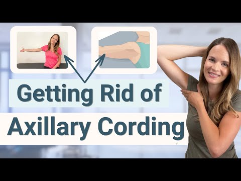 Axillary Web Syndrome and Cording Treatment – How to Get Rid of Cording [Video]