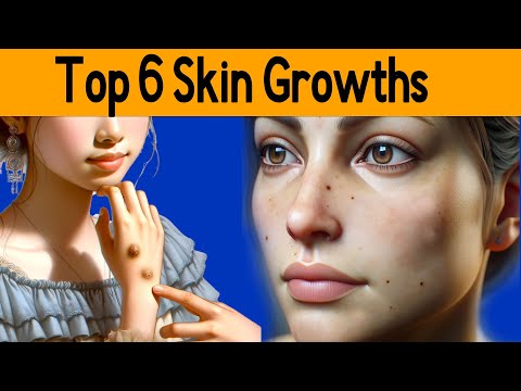 Top 6 six skin growths: From Moles to Warts – A Complete Guide [Video]