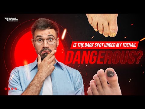 Is the Dark Spot Under My Toenail Dangerous? [Video]