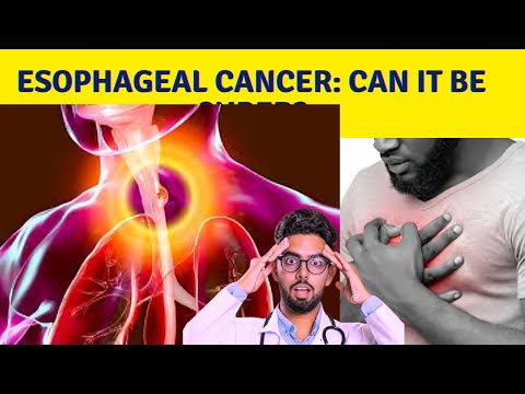 Is esophageal cancer ever cured? [Video]