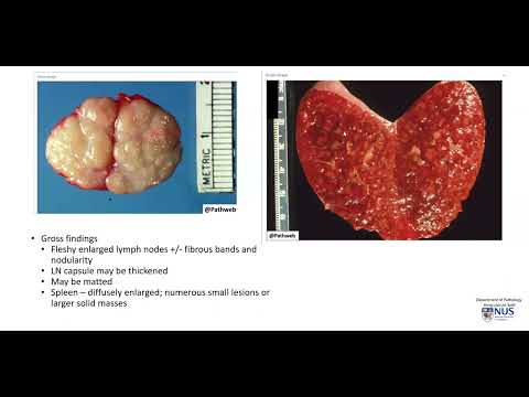 Lymph node and Spleen: Hodgkin lymphoma (Gross pathology) [Video]