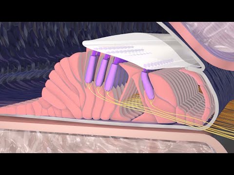 Hearing Loss Due to Nerve Damage [Video]