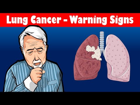 Look Out For These Symptoms, You May Be Having A Lung Cancer!!! Warning Signs Of Lung Cancer [Video]