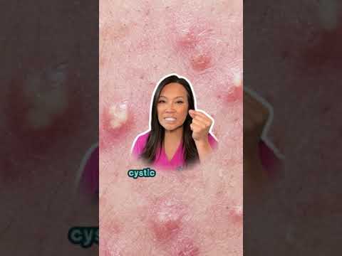 If you have mild to moderate acne and maybe don’t have easy access to a dermatologist… [Video]