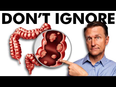 The Early Signs of Colon Cancer You DON’T Want to Ignore [Video]