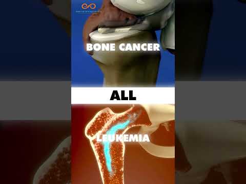Are Bone Cancer & Leukemia the Same Thing or Different? [Video]