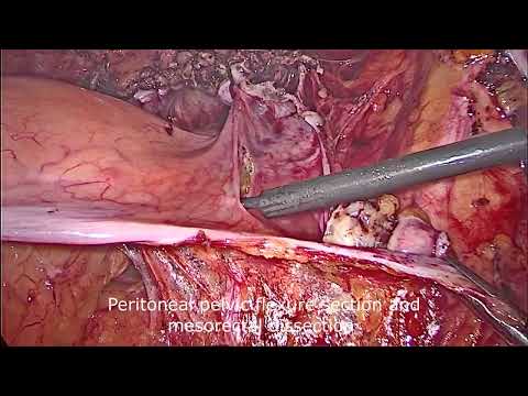 Laparoscopic hysterectomy and total colectomy with TTSS [Video]