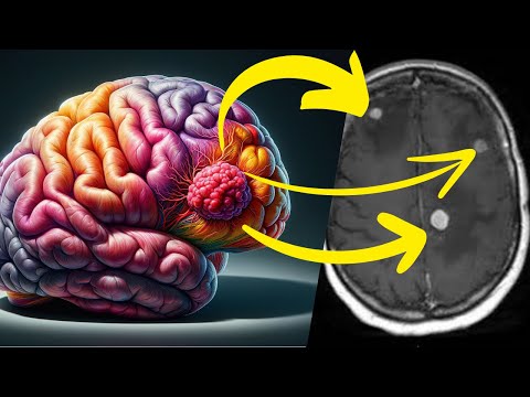 Brain Tumors – A Masterclass in Medicine For Metastatic Cancer In The Brain [Video]