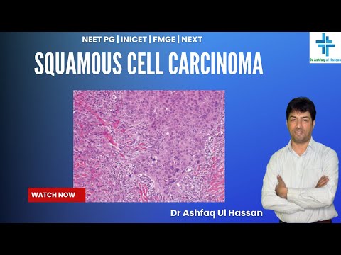 Squamous Cell Carcinoma  I FMGE I NEET Pg I USMLE I PLAB I INICET I MRCP [Video]