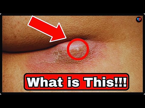 What Causes Lumps Under The Skin?  And How To Treat It Naturally | Skin Lump | Healthy Wellbeing [Video]