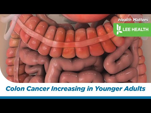 Colon Cancer Increasing in Younger Adults [Video]