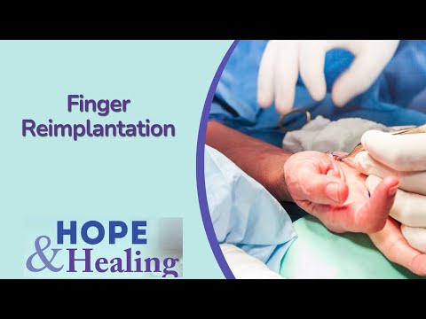 Replantation Of Finger | Treating Hand Pain Town Hall [Video]